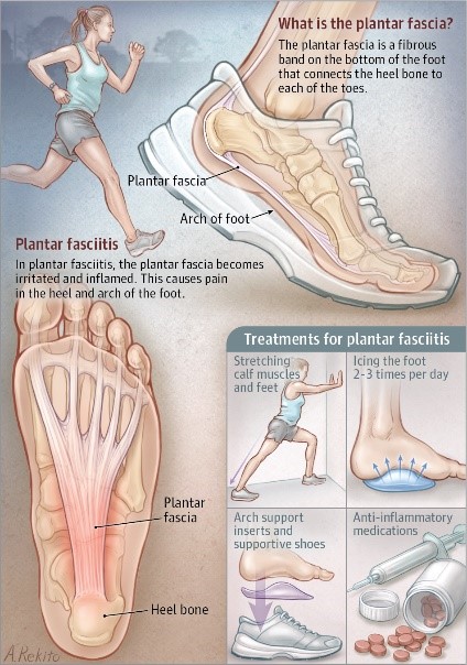 Heel Pain Plantar Fasciitis is a common and Painful Condition